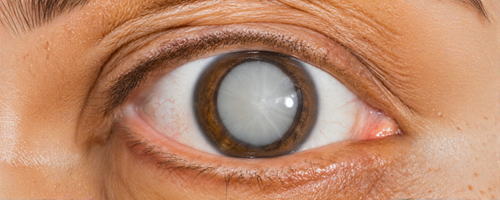 Cataract Management